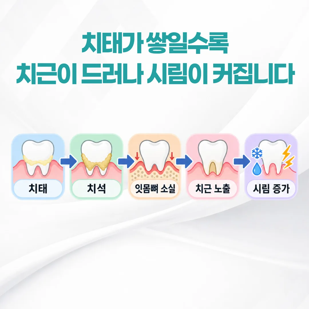 치태가 치석이 되고 잇몸뼈가 무너지며 치아 뿌리가 드러나 시림이 커지는 흐름을 나타낸 관계도