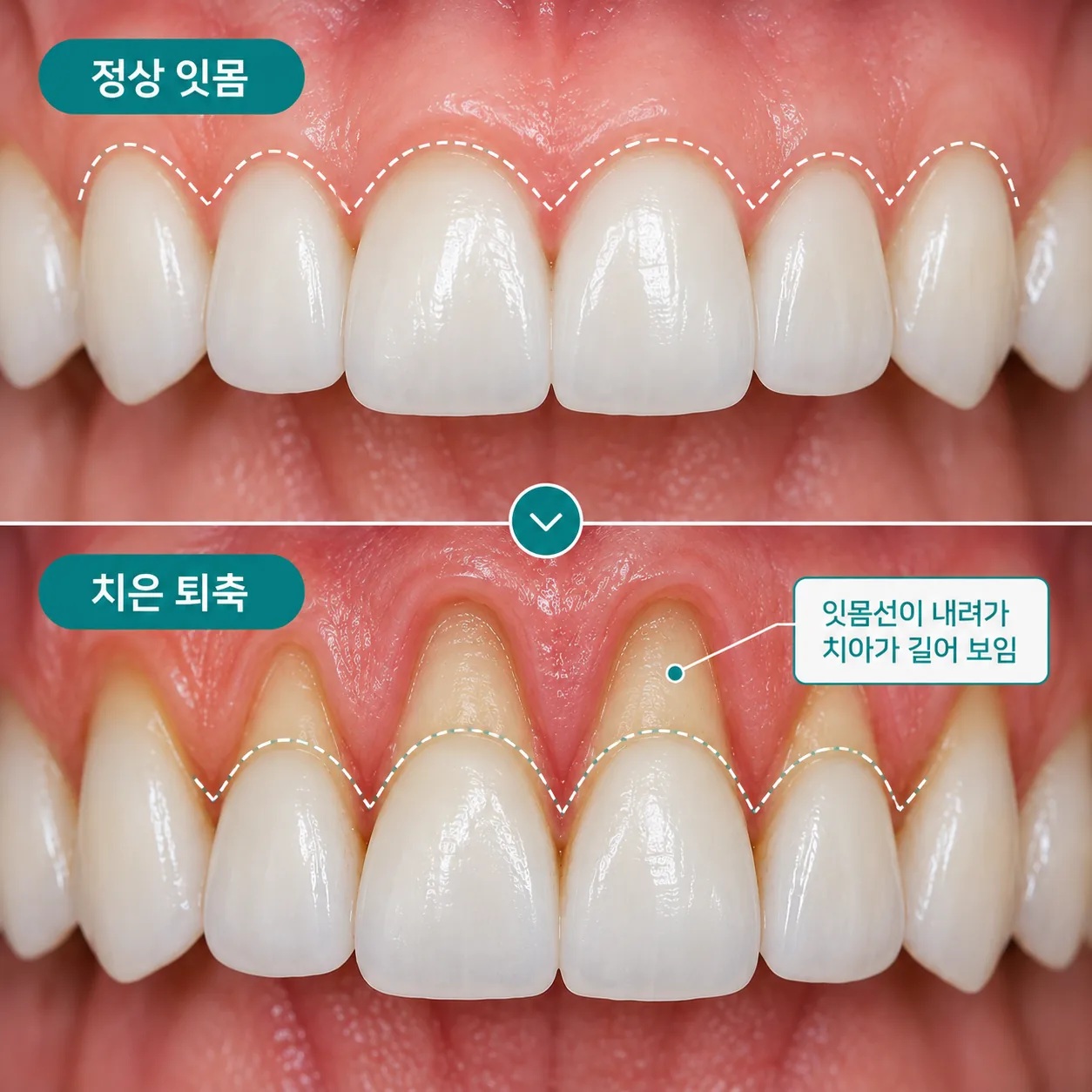 치은 퇴축으로 잇몸선이 내려가 치아가 길어 보이는 상태 개념도