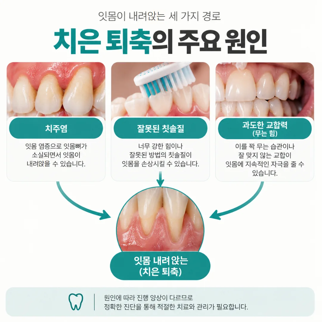 치주염, 잘못된 칫솔질, 과도한 교합력으로 나뉘는 잇몸 퇴축 원인 관계도