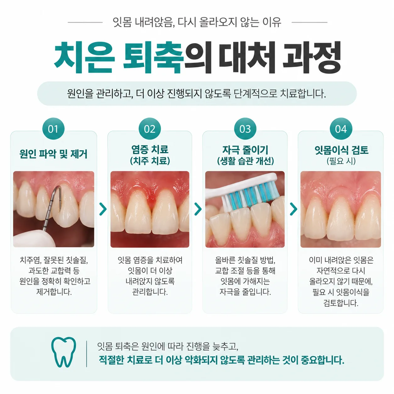 염증 치료와 자극 줄이기를 거쳐 잇몸이식 검토로 이어지는 치은 퇴축 대처 순서도