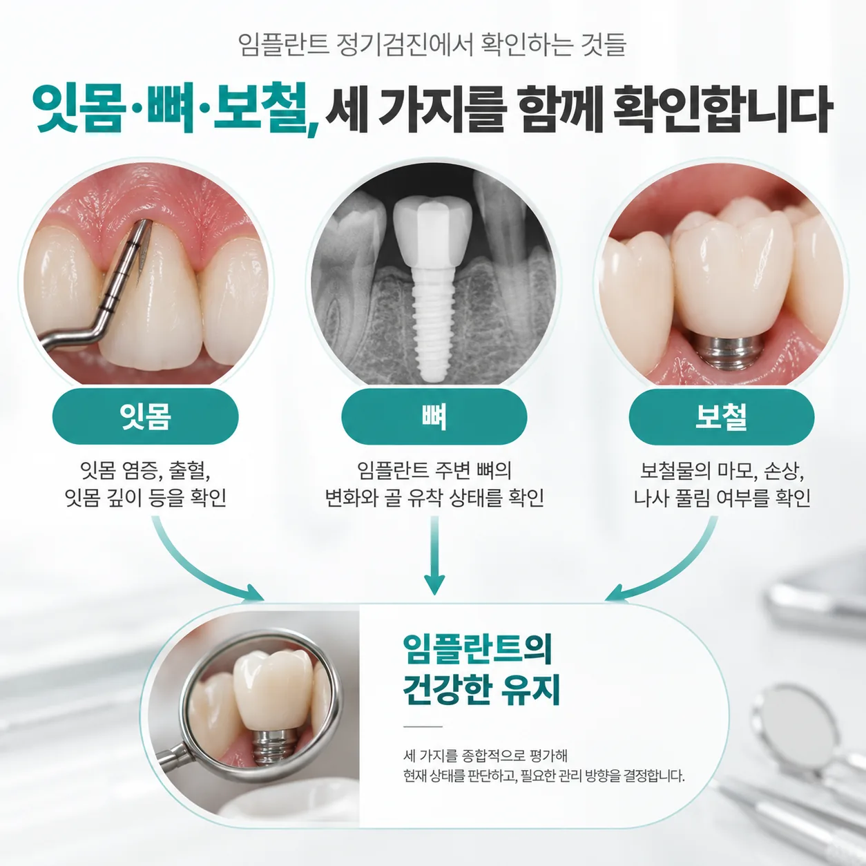 임플란트 정기검진에서 확인하는 잇몸·뼈·보철 세 영역 개념도