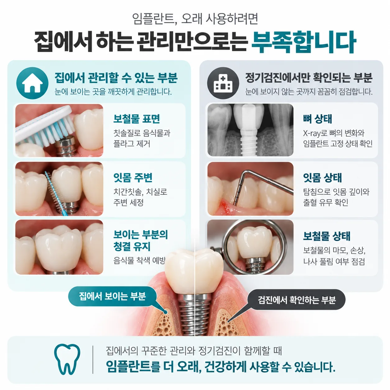 임플란트 홈케어로 닿는 범위와 정기검진에서만 확인되는 범위 비교도