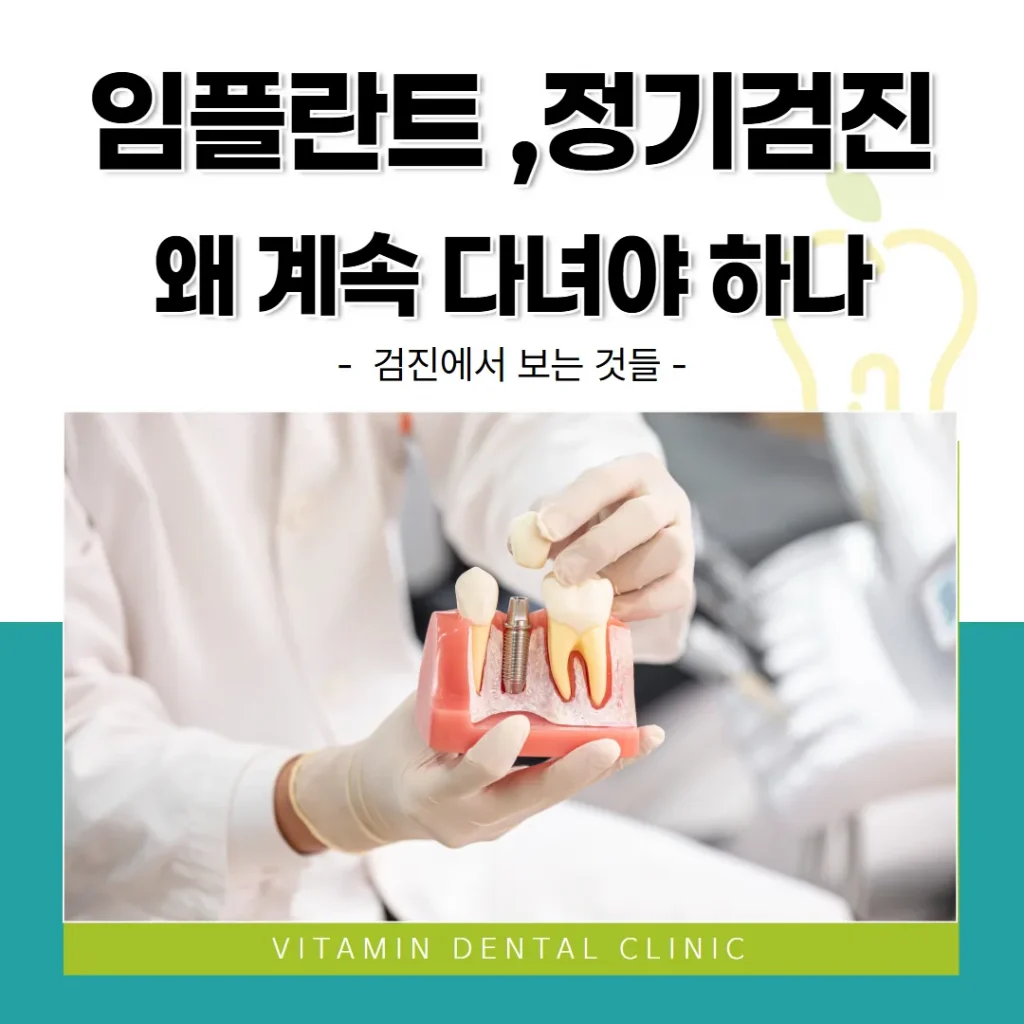 임플란트 정기검진, 왜 계속 다녀야 하나 — 검진에서 보는 것들