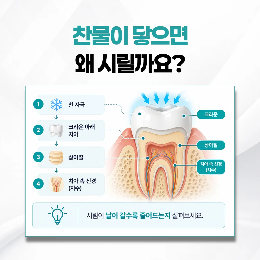 크라운을 씌운 치아의 단면과 찬 자극이 치아 속 신경으로 전해지는 경로 개념도