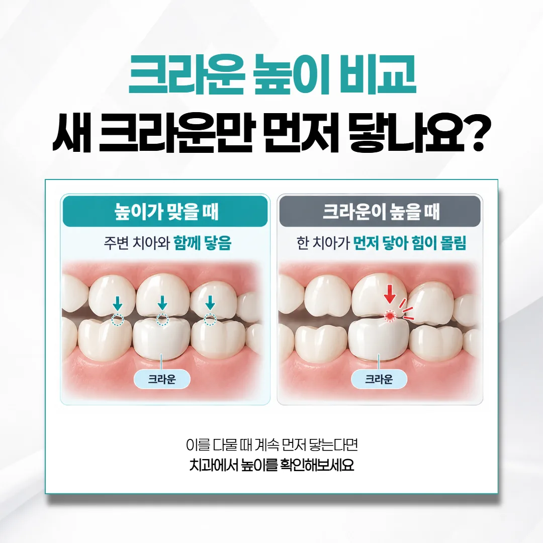 높이가 맞는 크라운과 한 점이 먼저 닿는 높은 크라운의 맞물림 비교 그림
