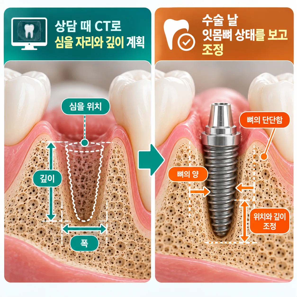 CT로 세운 임플란트 계획이 수술 날 판단으로 이어지는 잇몸뼈 단면 개념도