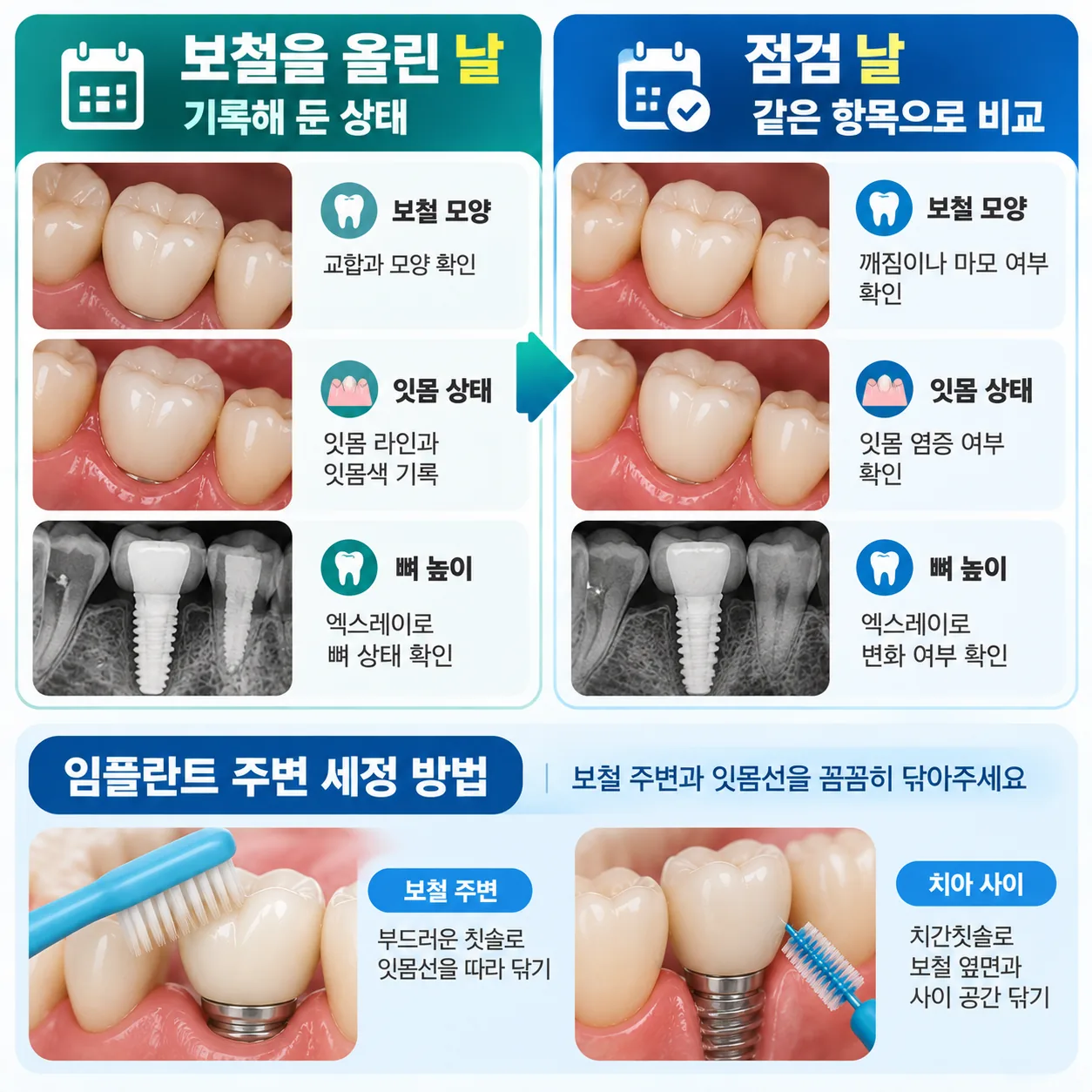 보철을 올린 날 기록과 점검 날 상태를 비교하는 임플란트 사후관리 카드