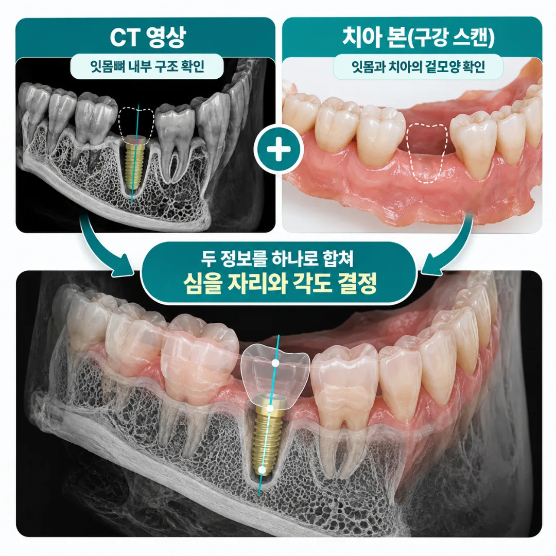 CT 영상과 치아 본 정보를 남아 있는 치아 기준으로 겹치는 임플란트 디지털 진단 도식
