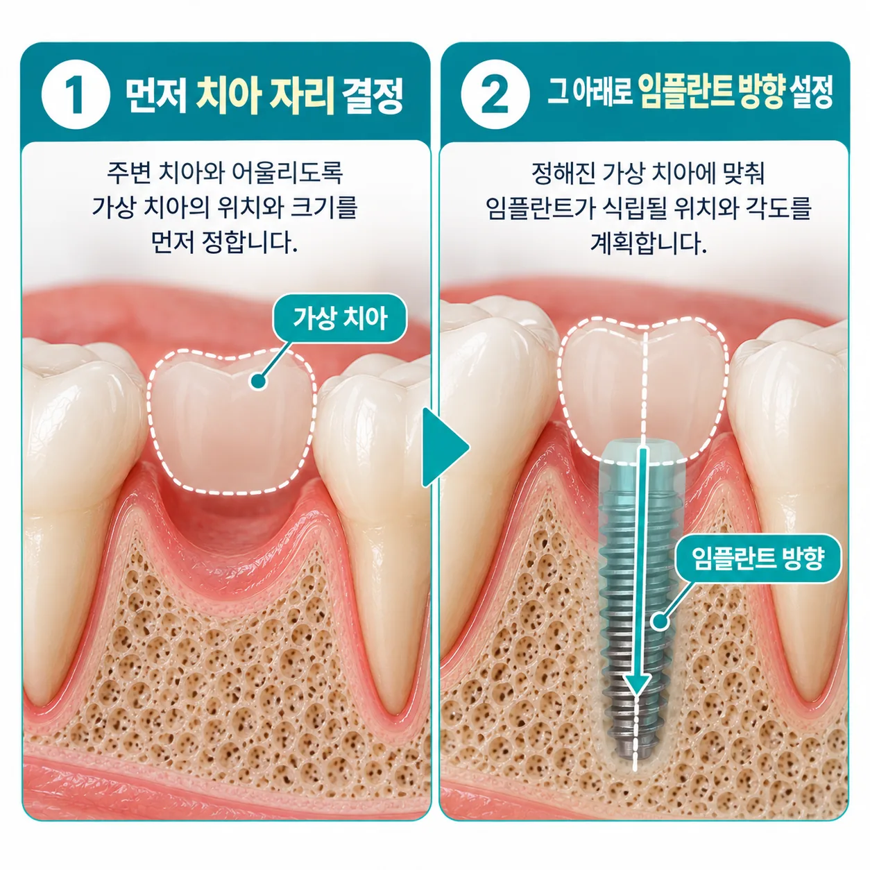 가상 치아 자리를 먼저 정하고 그 아래로 임플란트 방향을 맞추는 순서 개념도