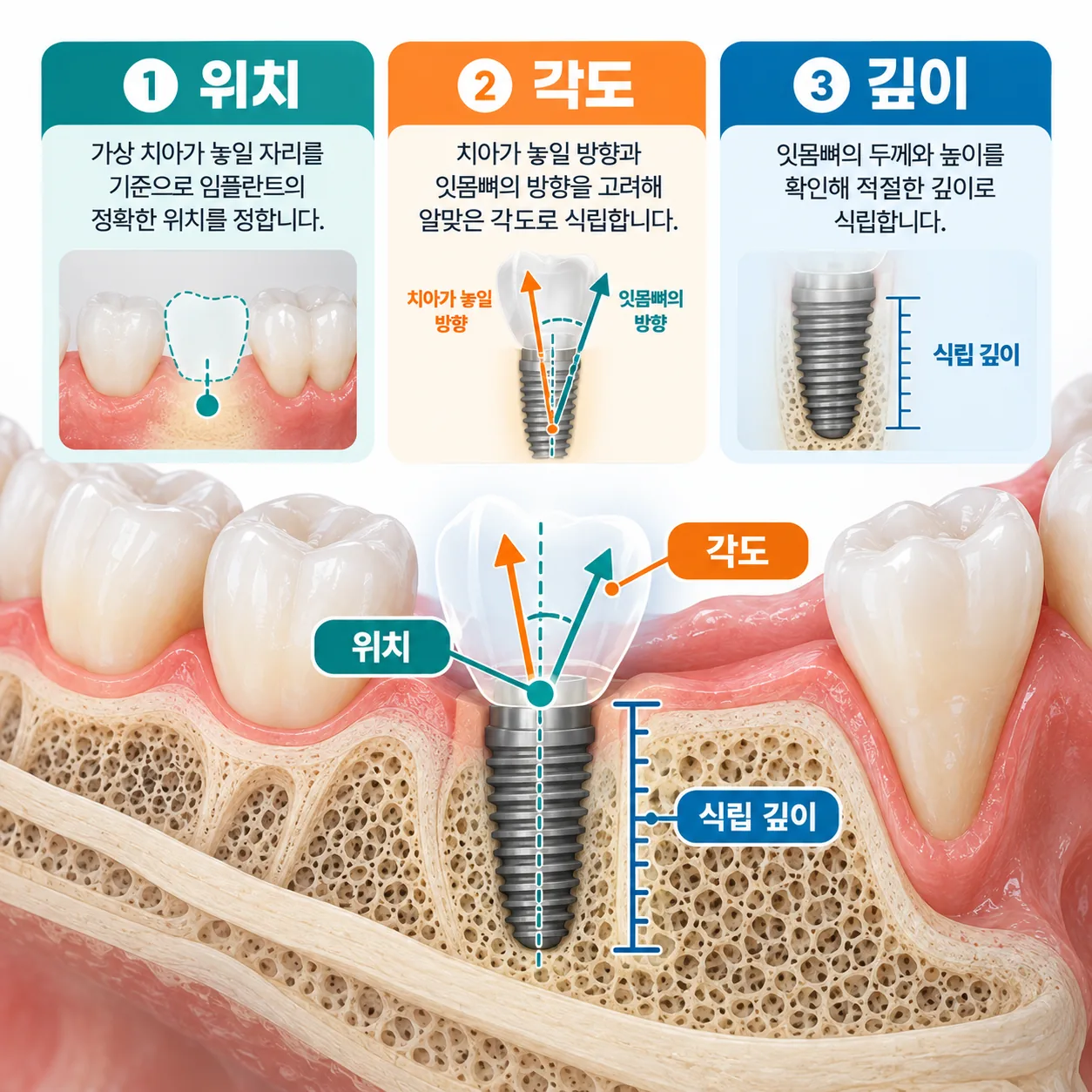 잇몸뼈 단면에 임플란트의 위치와 각도와 깊이를 표시한 설명 그림