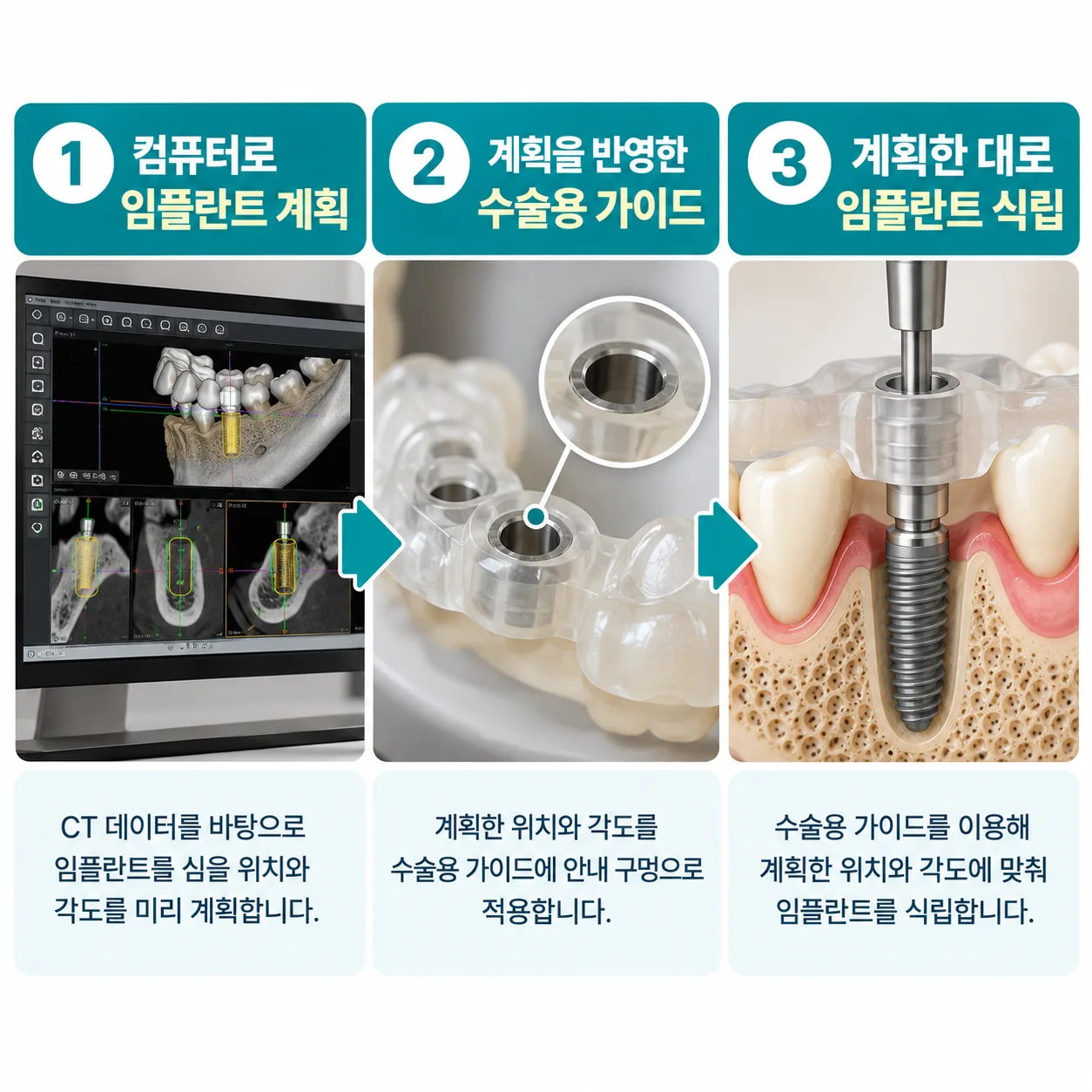 화면에서 세운 임플란트 계획이 수술용 가이드의 안내 구멍으로 옮겨지는 흐름도