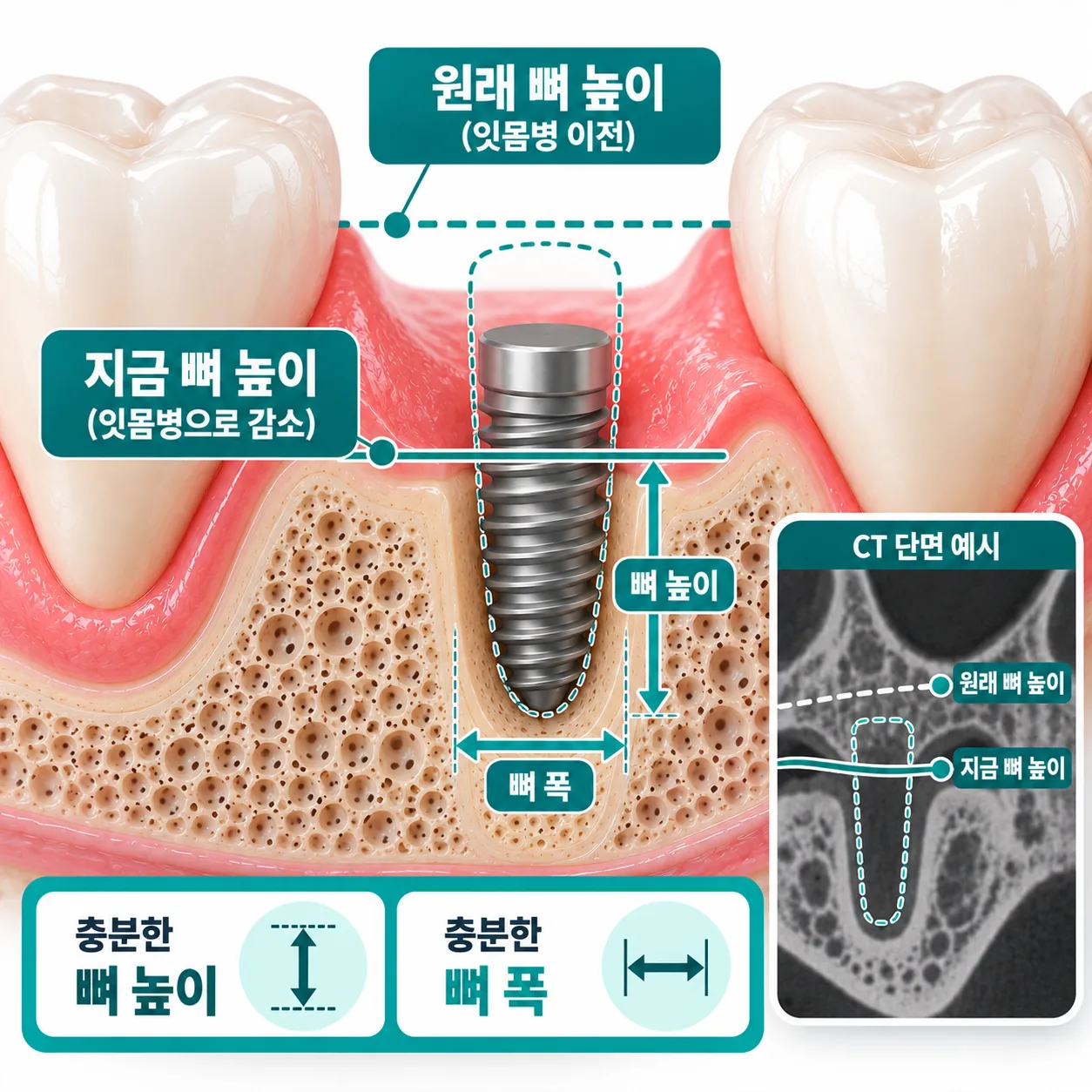 CT 단면에서 잇몸병으로 낮아진 잇몸뼈 높이와 폭을 심을 자리에 맞춰 보는 설명 그림