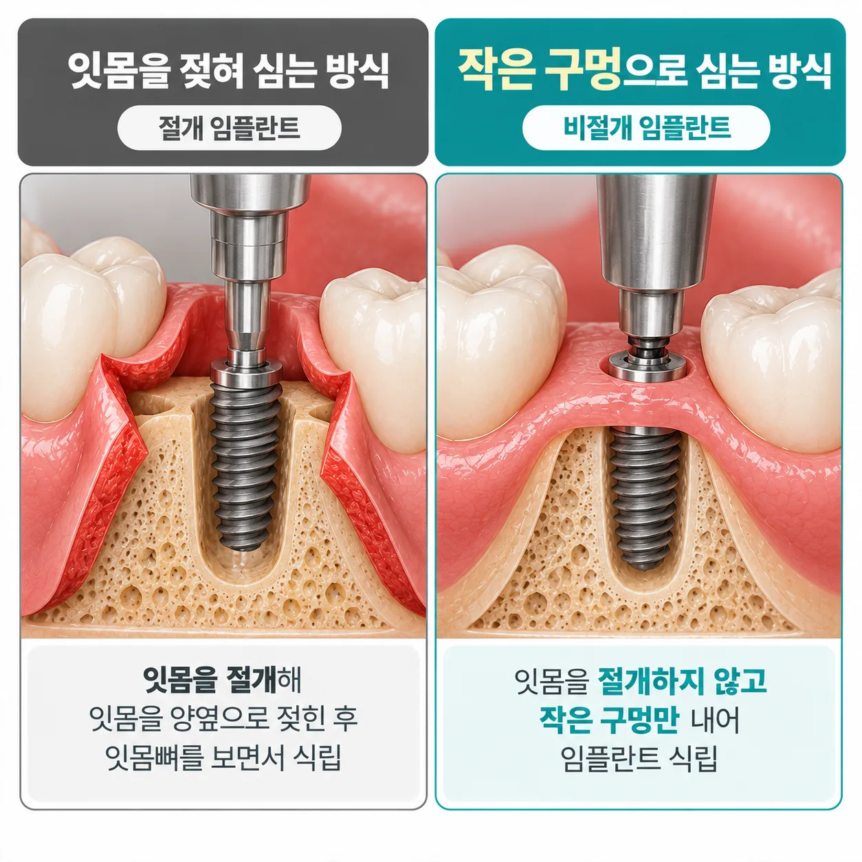 잇몸을 젖혀 심는 방식과 작은 구멍으로 심는 비절개 방식의 단면 비교 도식