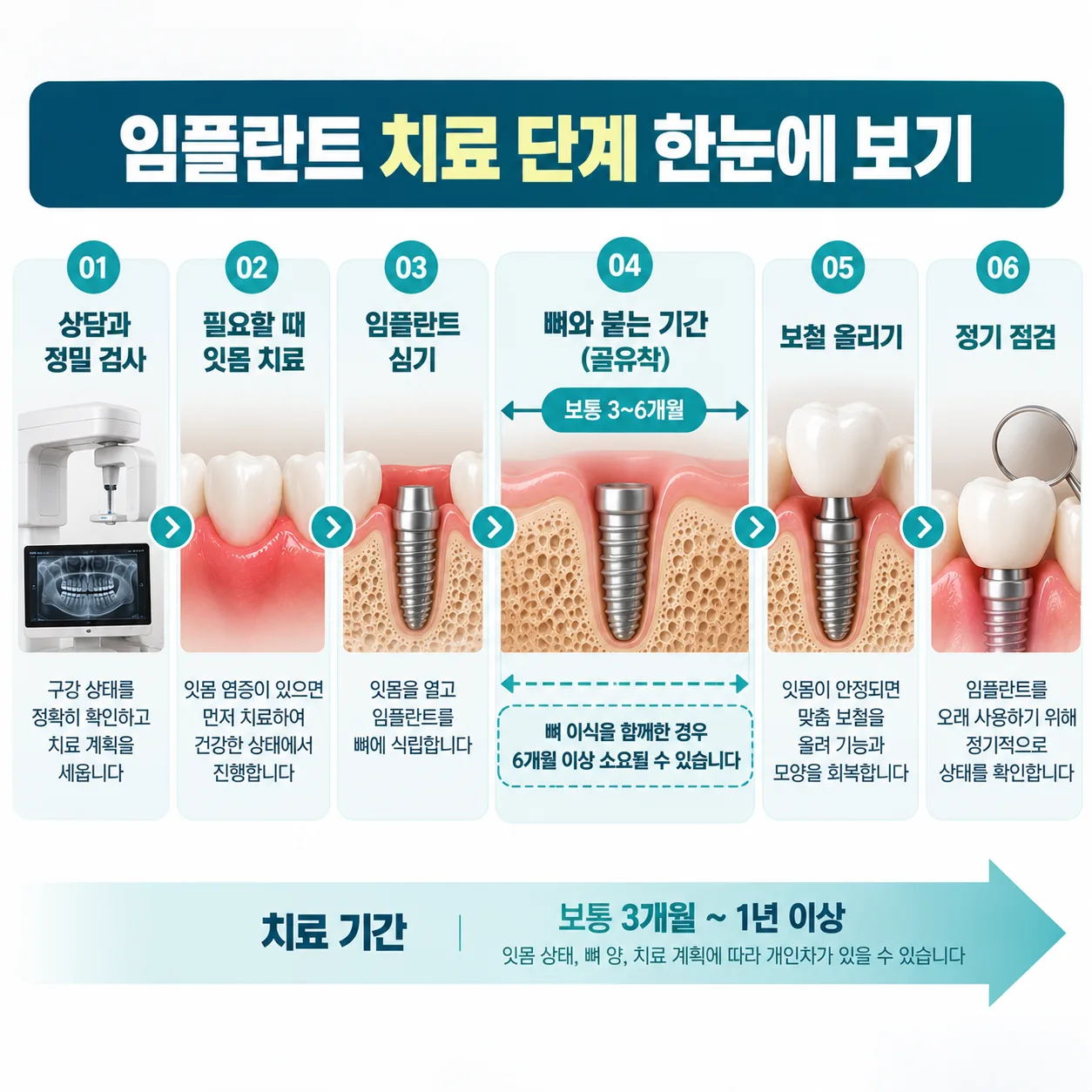 상담부터 임플란트 심기, 뼈와 붙는 기간, 보철, 정기 점검까지 이어지는 치료 단계 흐름도