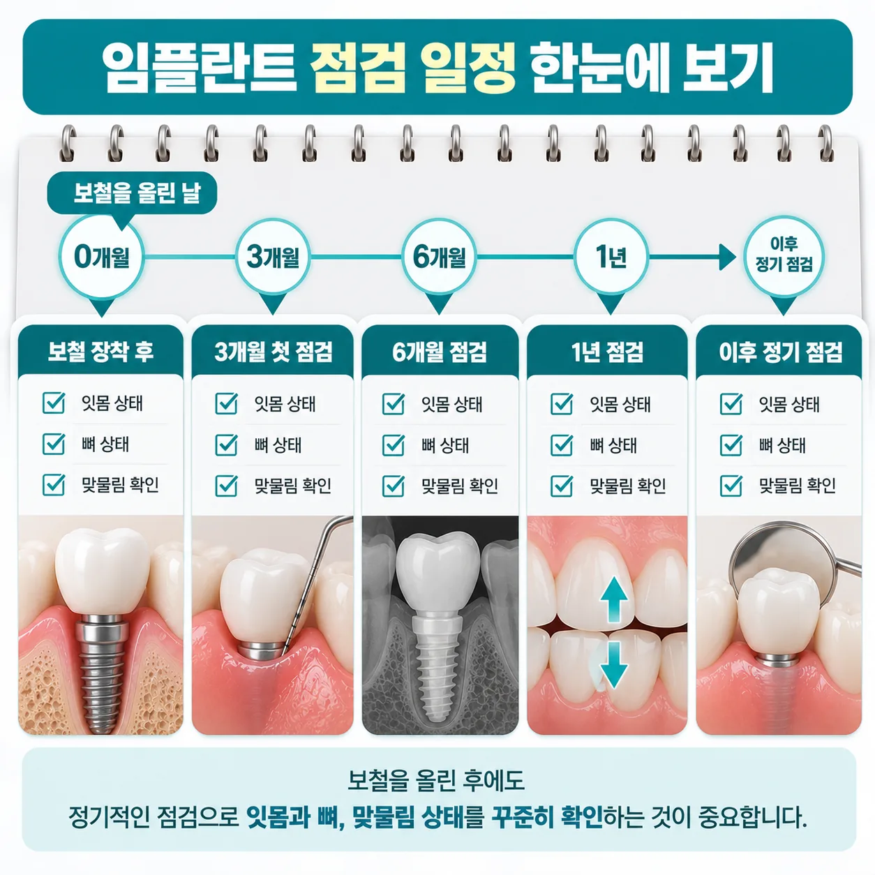 보철을 올린 날부터 이어지는 임플란트 점검 일정과 점검 때 살피는 잇몸, 뼈, 맞물림 일정표