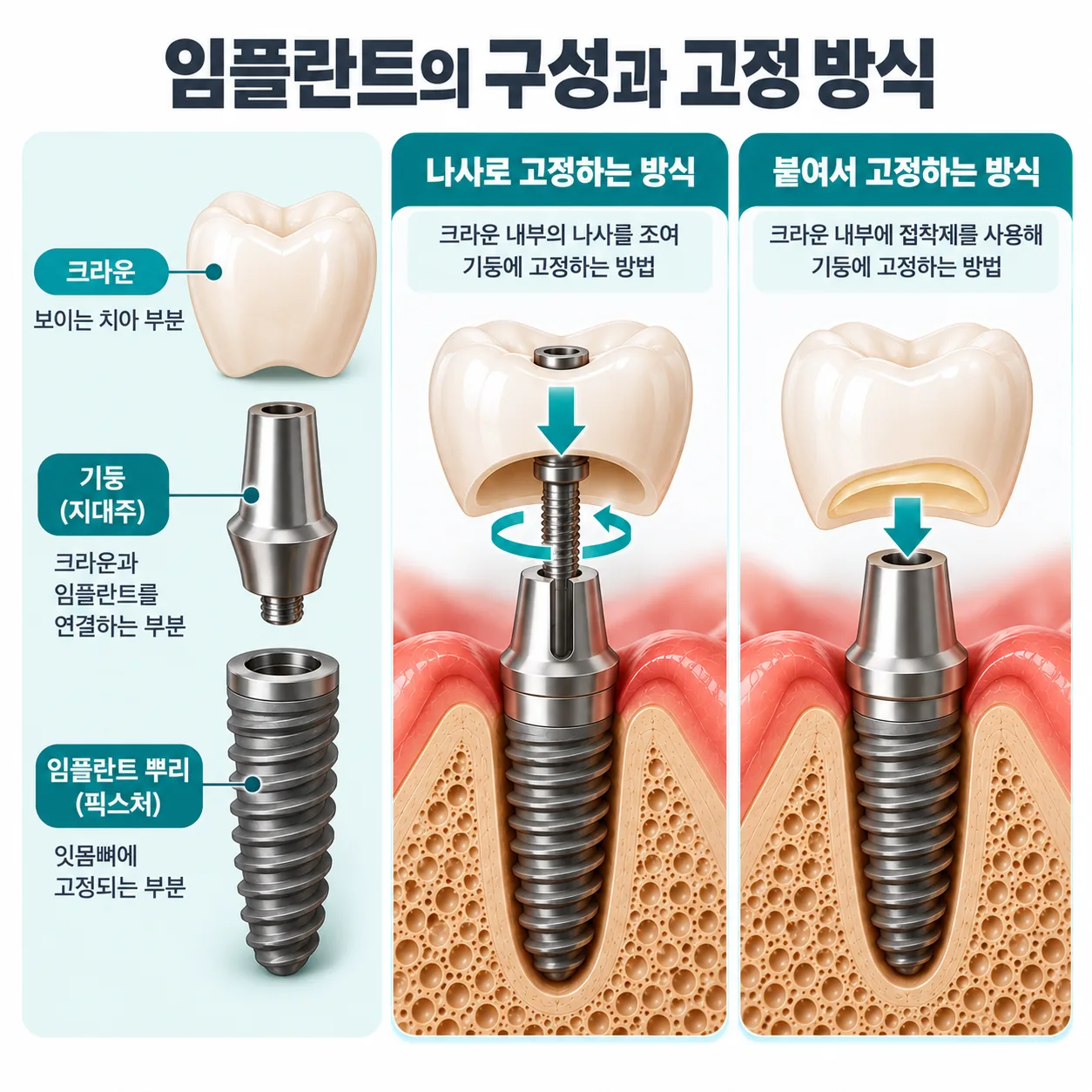 임플란트 뿌리와 기둥, 크라운 세 부분과 나사 고정, 접착 고정 두 방식의 단면 개념도