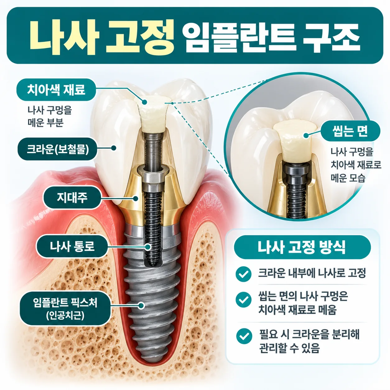 나사 고정 임플란트 크라운의 나사 통로와 메운 입구를 보여 주는 단면 개념도