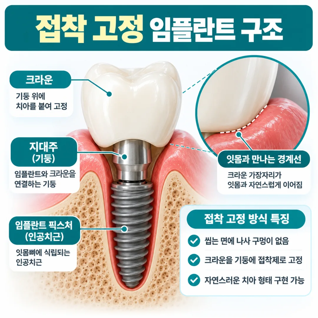 기둥 위에 크라운을 붙여 고정한 임플란트와 잇몸 경계선 단면 개념도