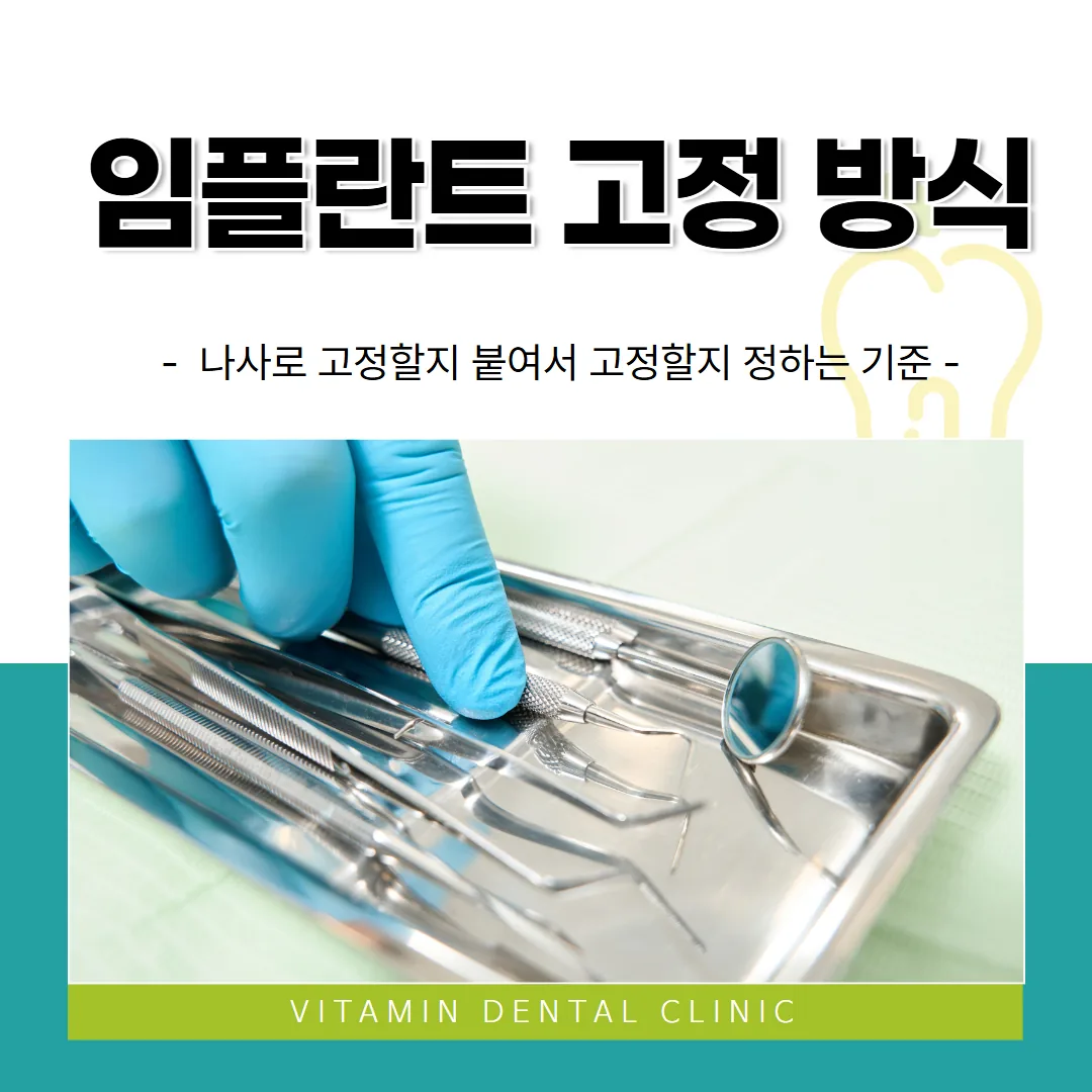 임플란트 고정 방식, 나사로 고정할지 붙여서 고정할지 정하는 기준