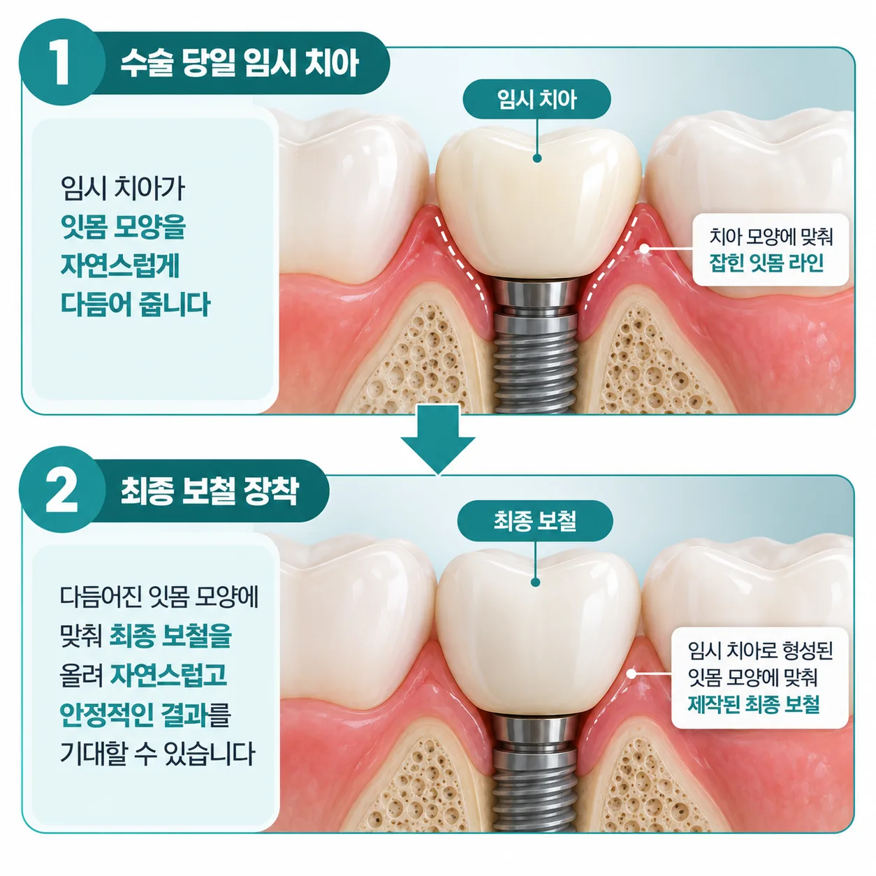 임시 치아로 다듬어진 잇몸 모양과 그 위에 올린 최종 보철 단면 개념도