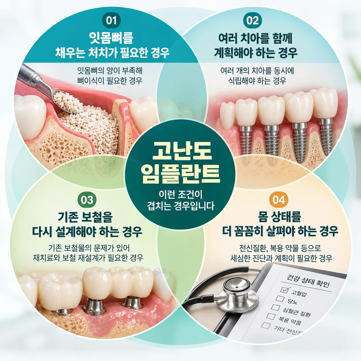 고난도 임플란트로 보는 네 가지 조건과 그 조건이 겹치는 경우를 나타낸 개념도