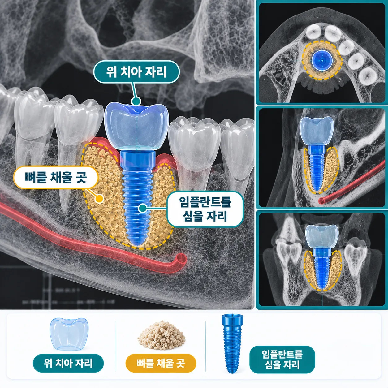 여러 조건을 한 화면에 함께 계획하는 임플란트 CT 설계 개념도