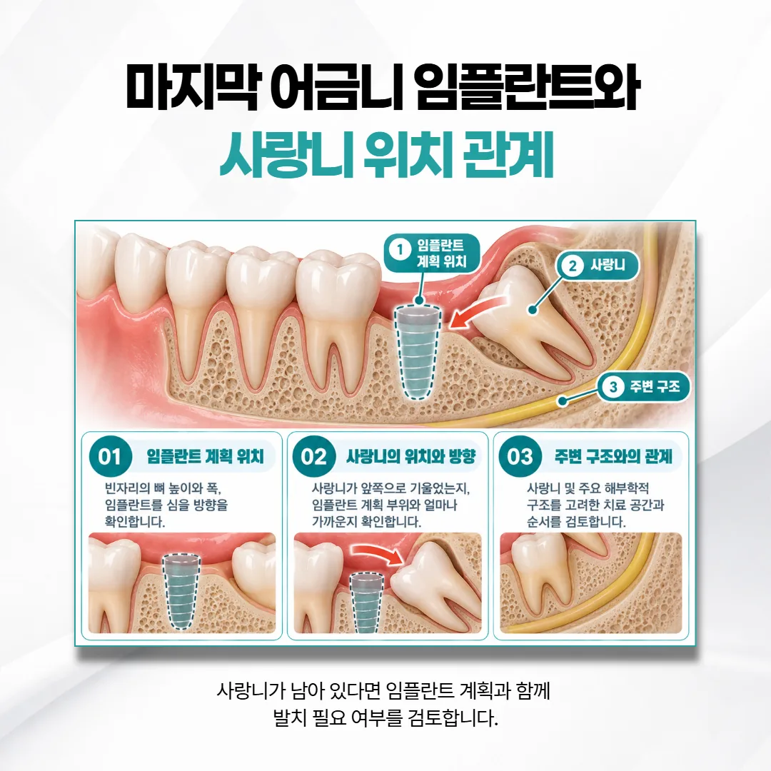 맨 뒤 어금니 빈자리의 임플란트 계획 위치와 뒤쪽 사랑니 기울기를 함께 보는 CT 단면 개념도