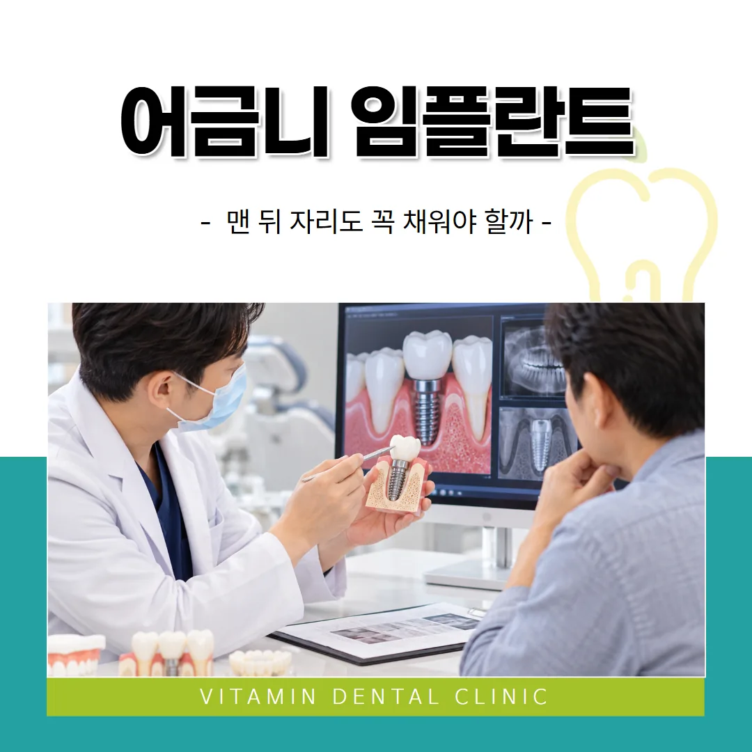 마지막 어금니 임플란트, 맨 뒤 자리도 꼭 채워야 할까