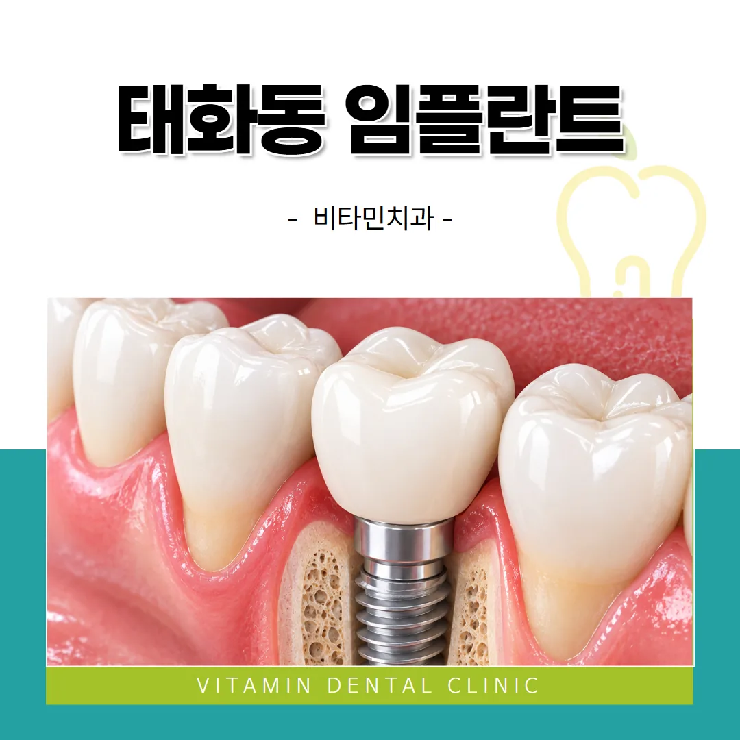 태화동 임플란트치과 찾는다면, 우정동 비타민치과 상담에서 듣는 설명