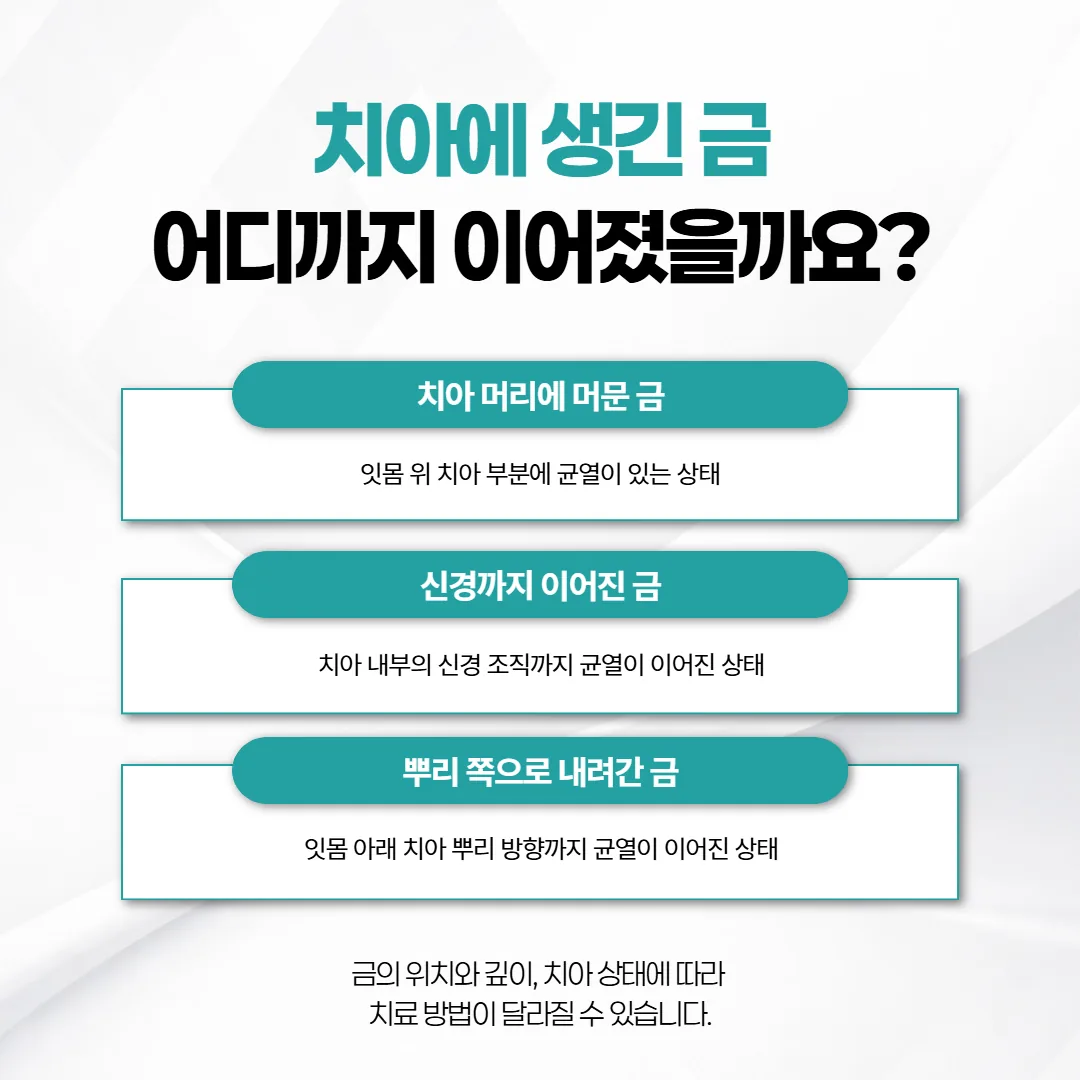 치아 머리에 머문 금과 신경까지 이어진 금과 뿌리로 내려간 금을 비교한 치아 단면 도식