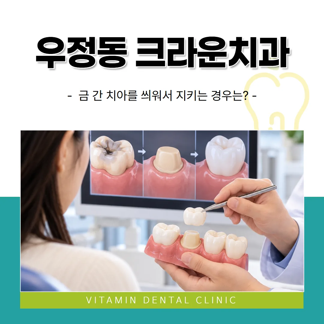 우정동 크라운치과, 금 간 치아를 씌워서 지키는 경우는?